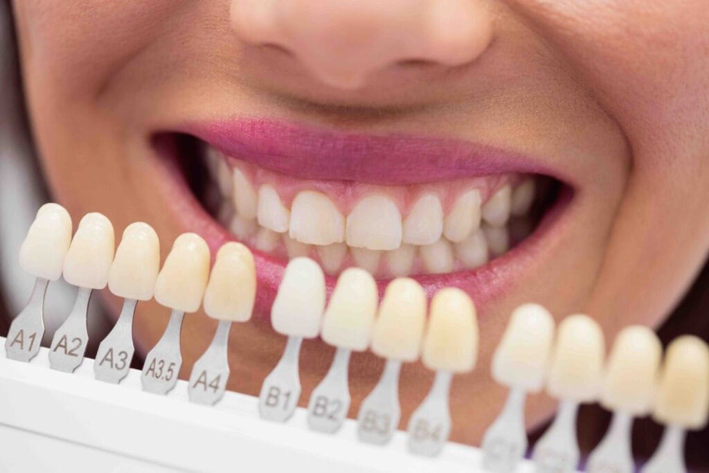 Quanto durano le faccette dentali 1 Quanto durano le faccette dentali