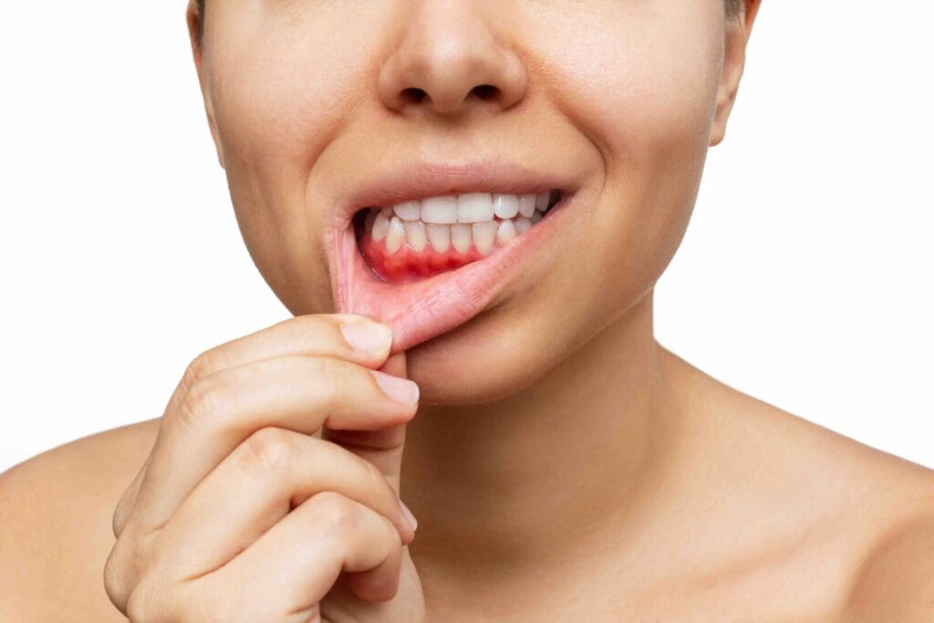 La guida completa su come si cura la parodontite ai denti 1 Come si cura la parodontite
